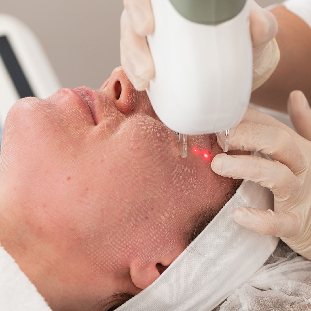 Laser rejuvenating facial face treatment at cosmetology clinic. Young woman getting lifting anti-aging and skincare, laser polishing facial therapy, aesthetic cosmetology.